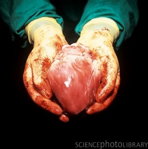 Heart transplant